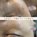 水光ピーリングケア継続でシミ改善_水光ピールスキン